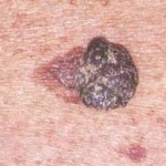 Il melanoma: l’importanza della diagnosi precoce