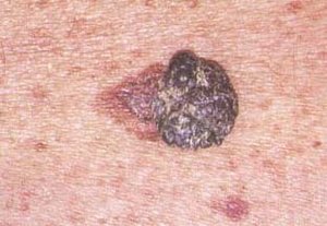 Il melanoma: l’importanza della diagnosi precoce
