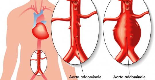 Aneurisma dell’aorta addominale